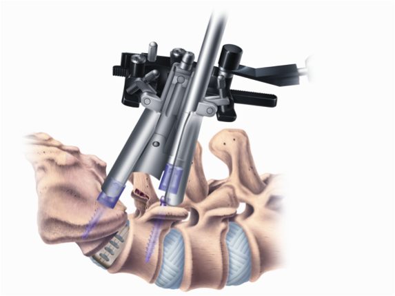 Minimally-Invasive TLIF Illustration